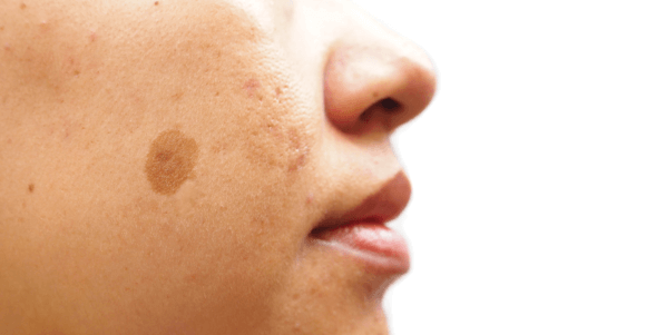 laser pigmentation treatment