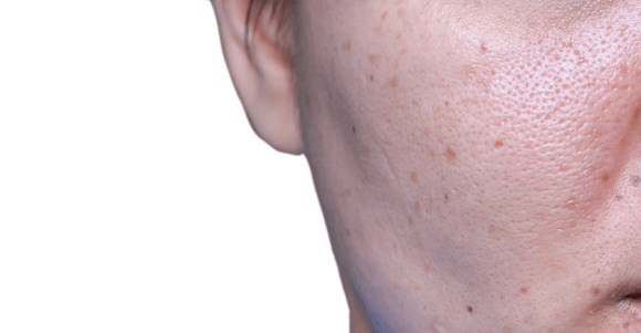 laser pore treatment