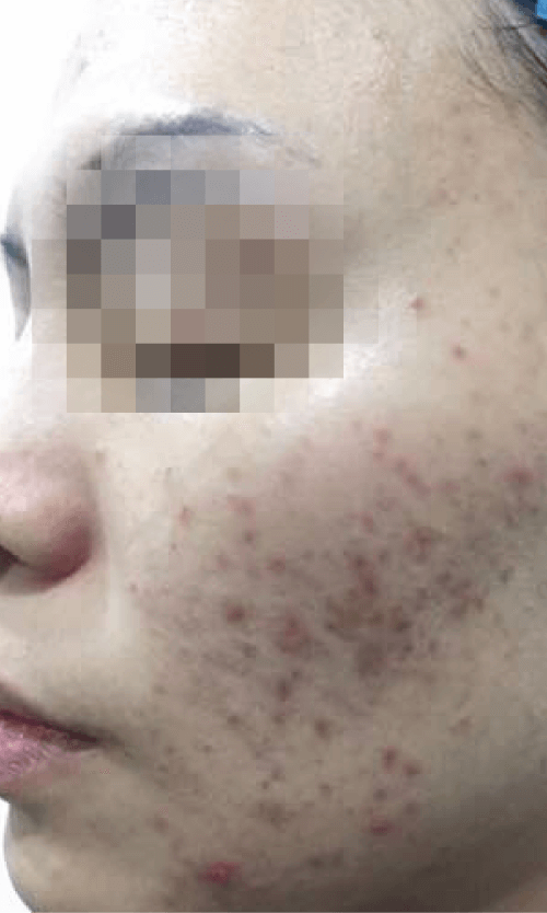 acne treatment malaysia