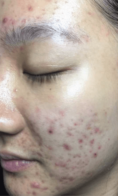 acne laser treatment