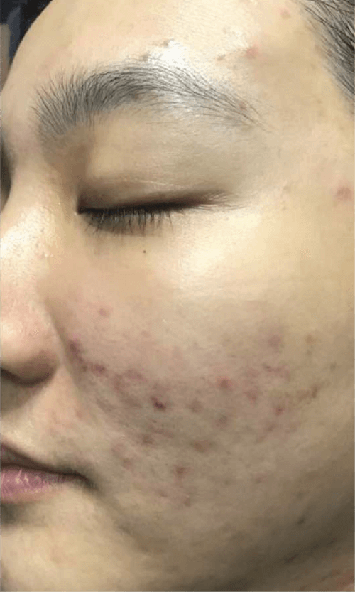 acne laser treatment