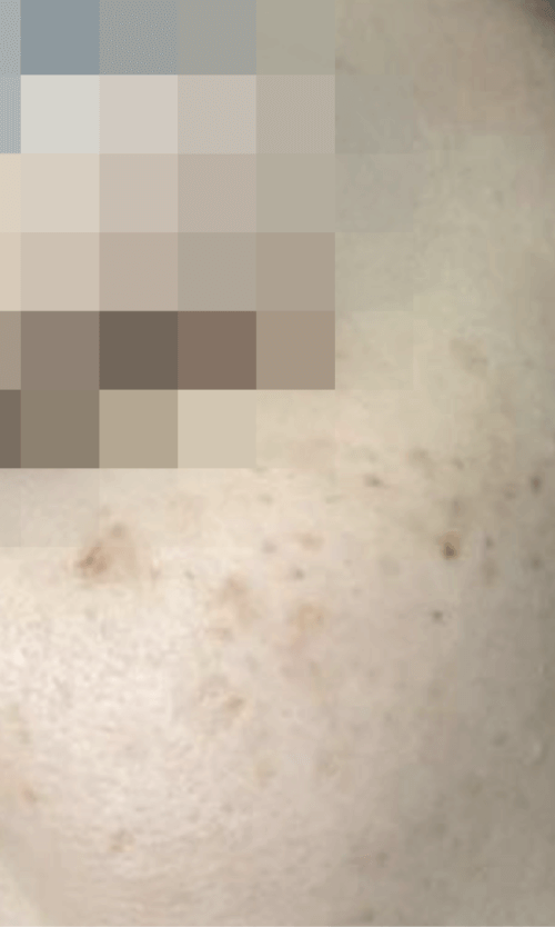 melasma laser treatment