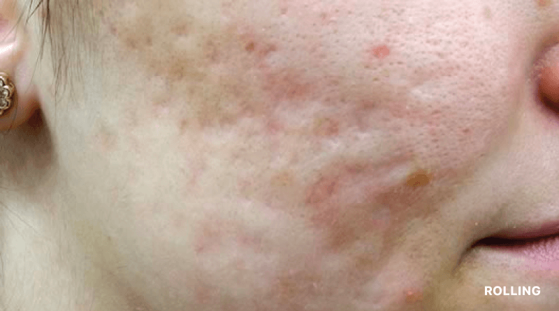 acne scars treatment malaysia