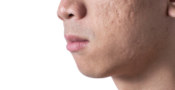 acne scars laser treatment