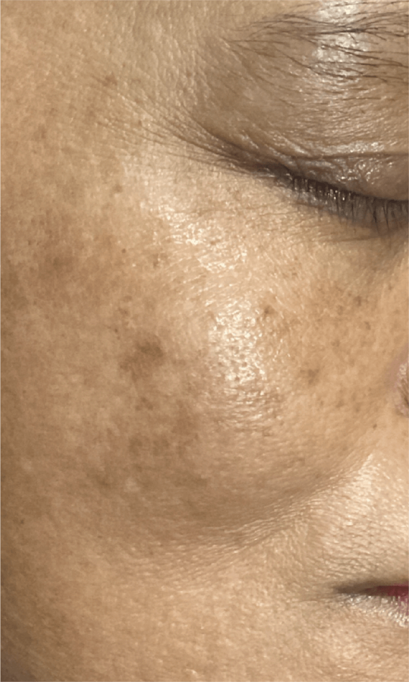 PICOPULSE treatment