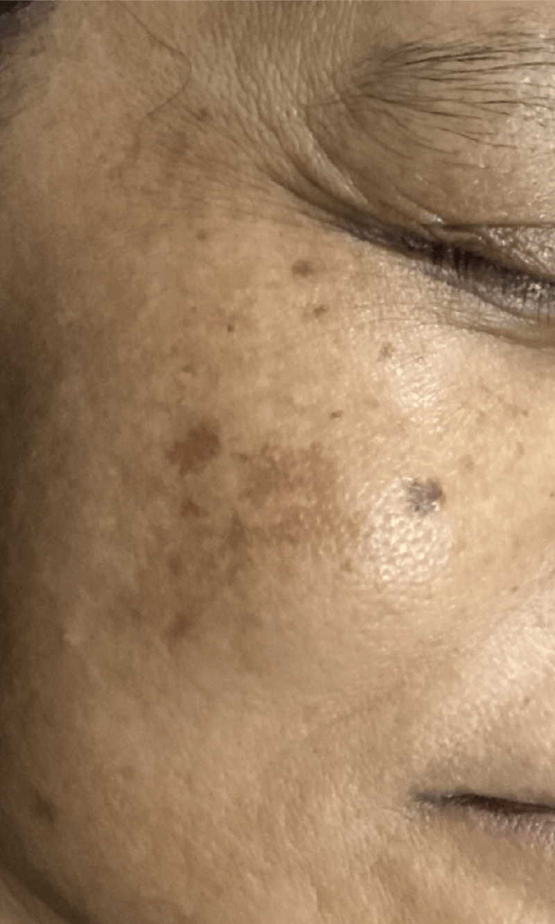 PICOPULSE treatment