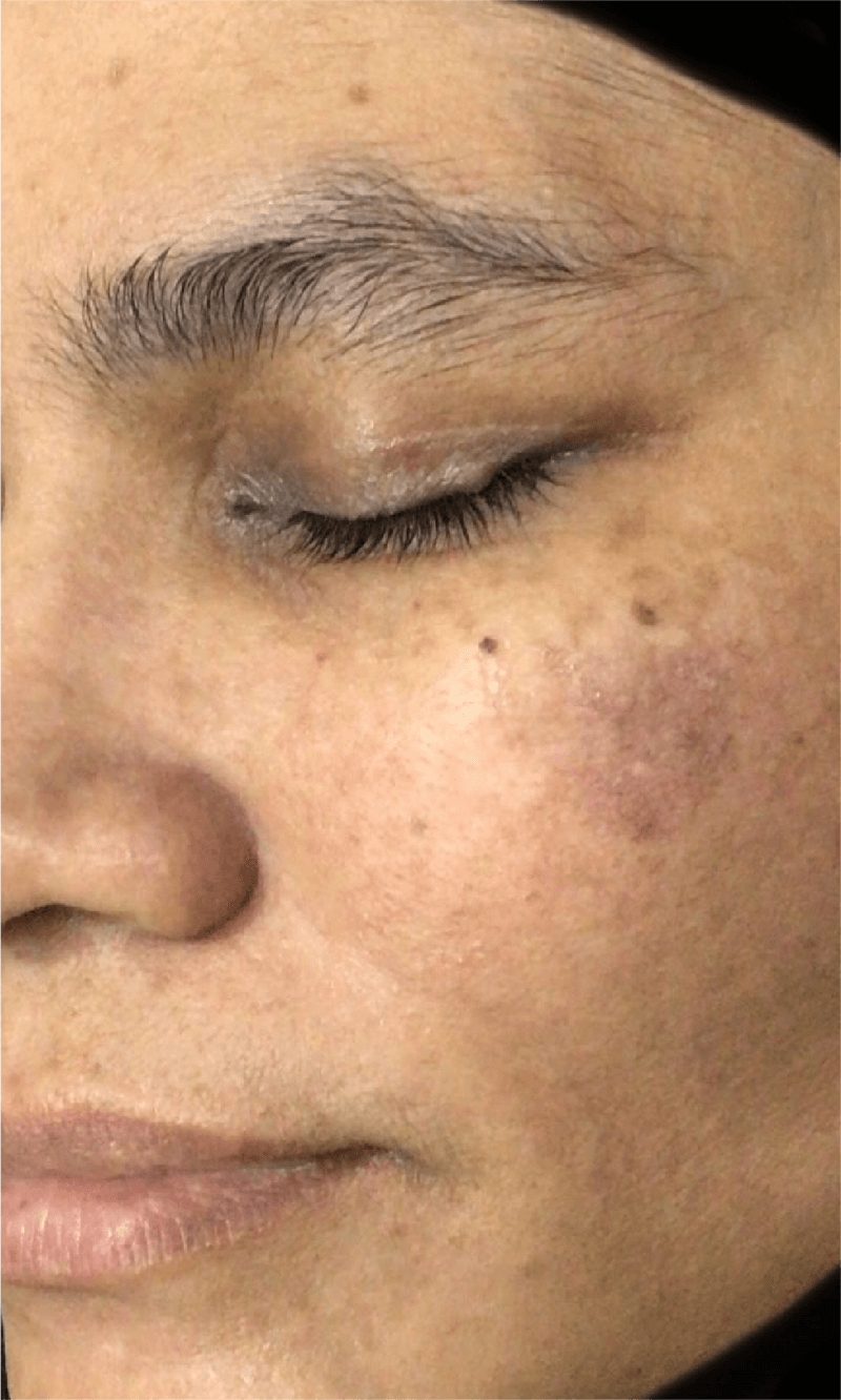 melasma laser treatment