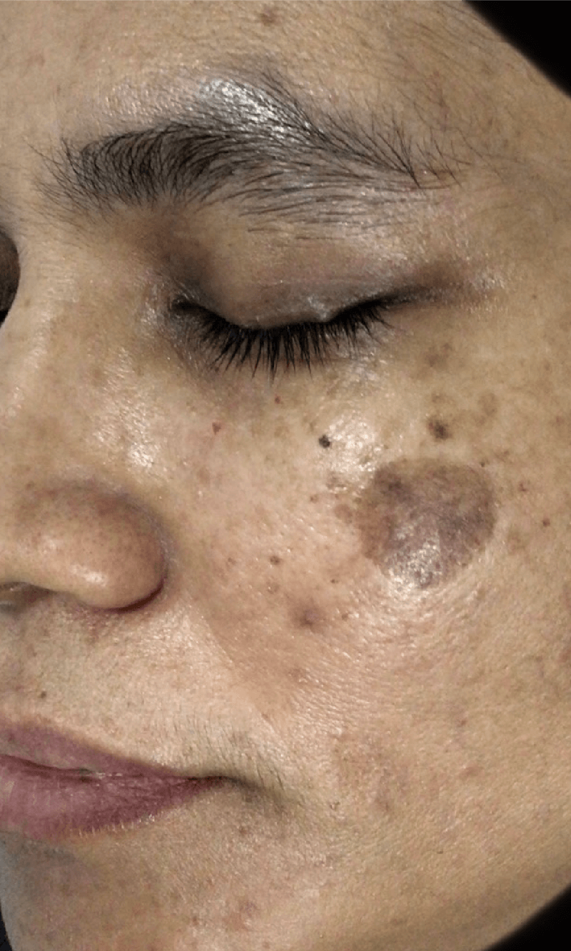 melasma laser treatment