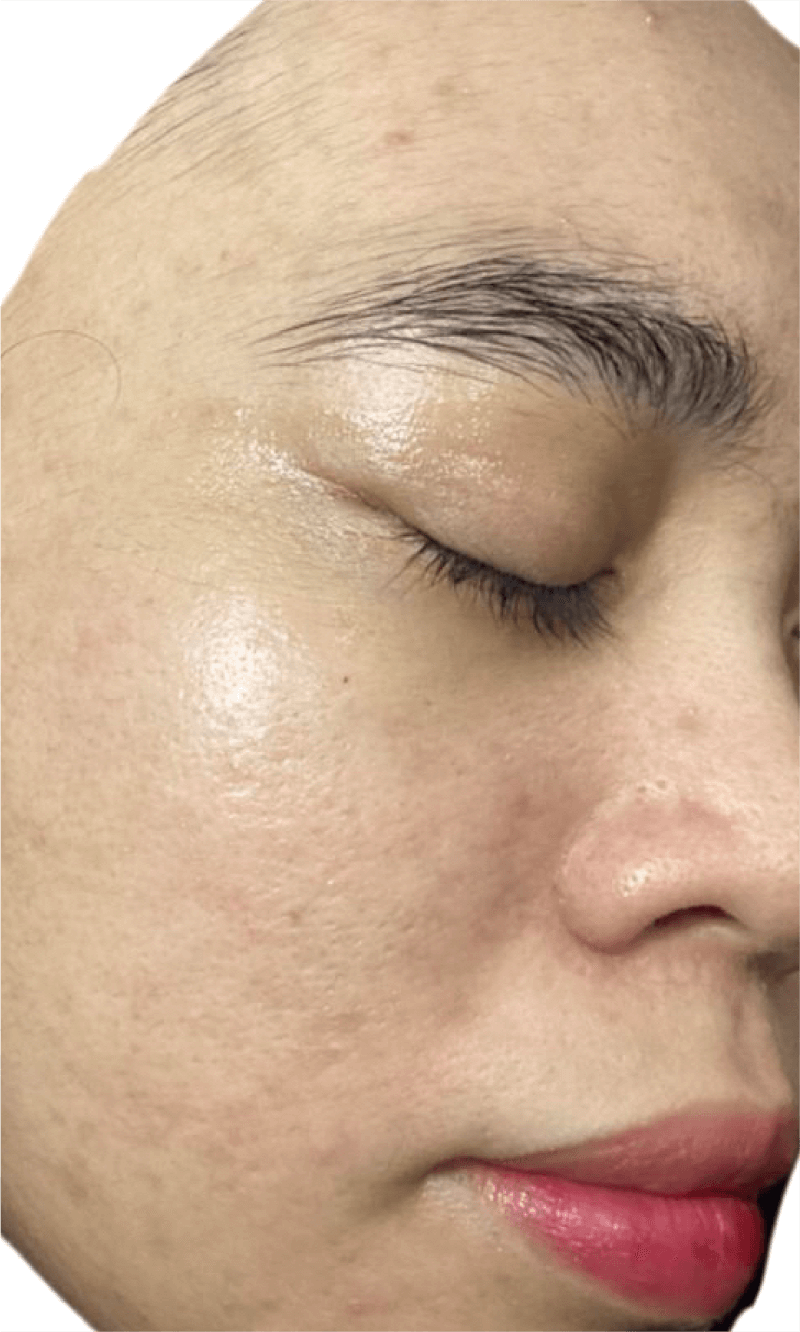 PICOPULSE treatment