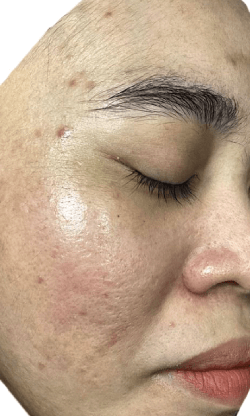 PICOPULSE treatment
