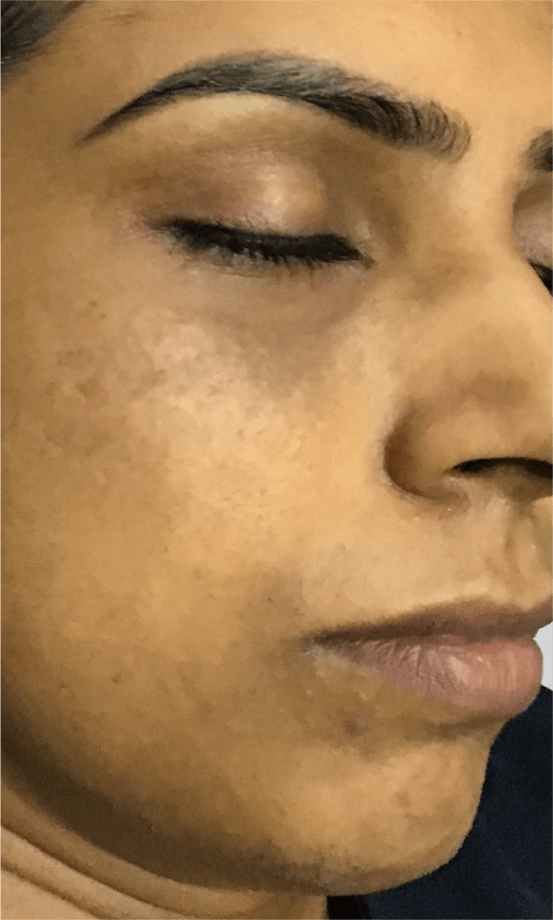 melasma laser treatment