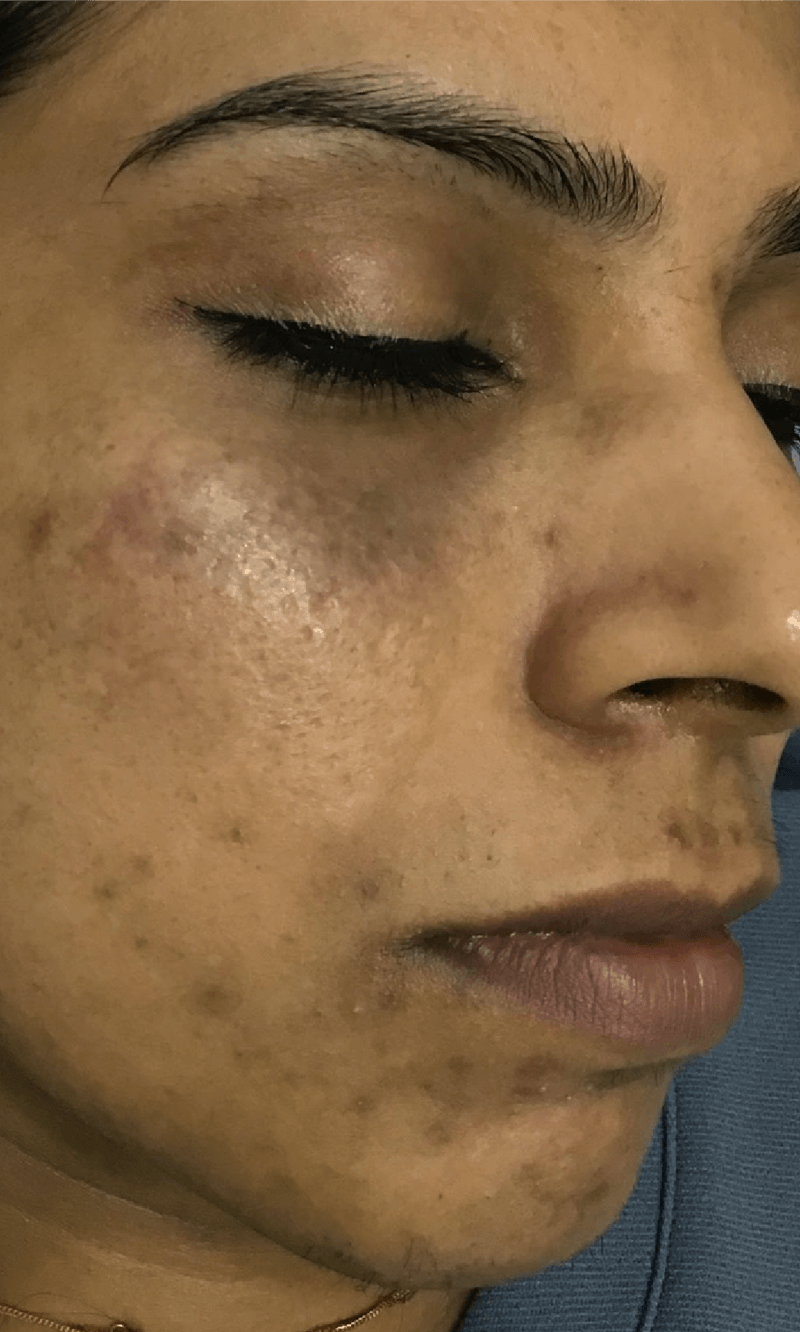 melasma laser treatment