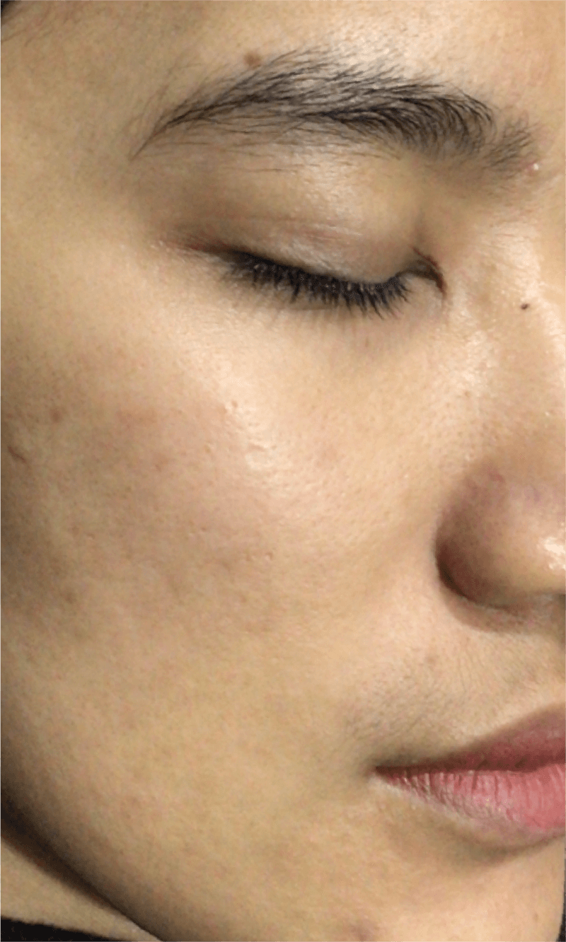 PICOPULSE treatment