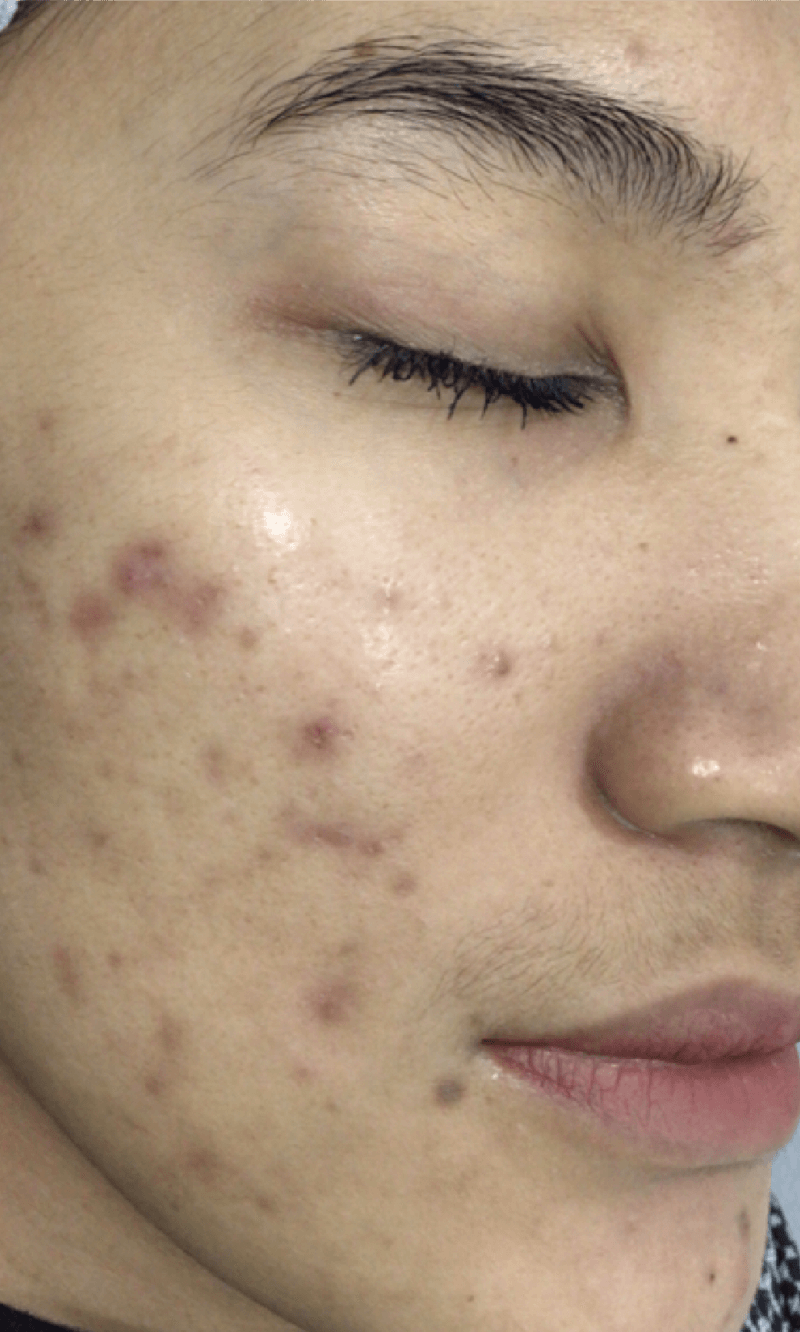 PICOPULSE treatment