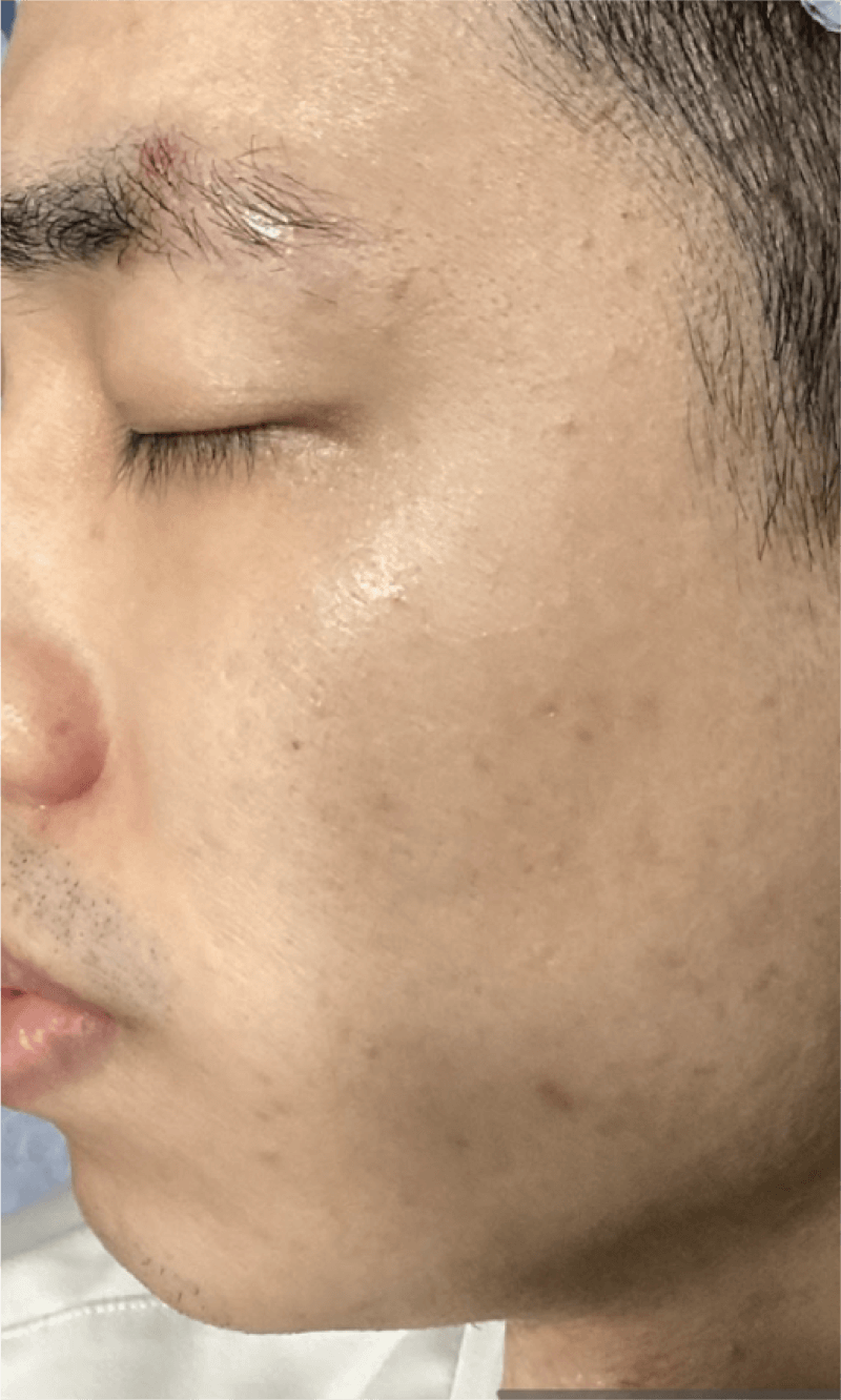 PICOPULSE treatment