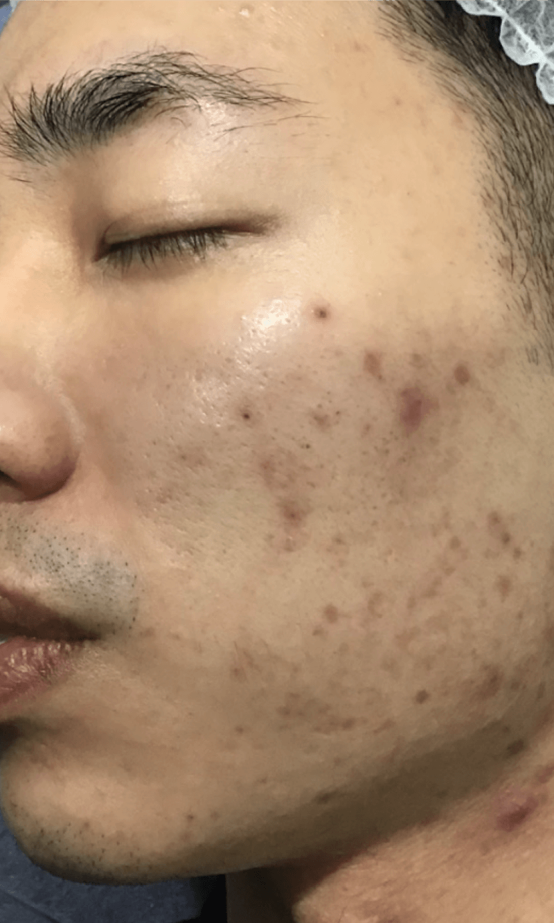 PICOPULSE treatment