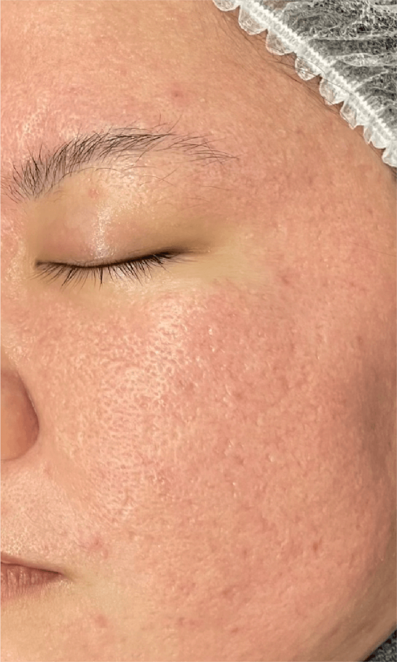 enlarged pores treatment malaysia