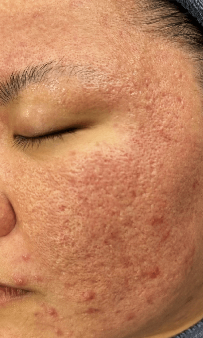 enlarged pores treatment malaysia
