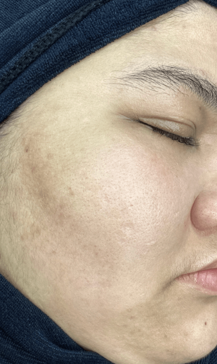 PICOPULSE treatment
