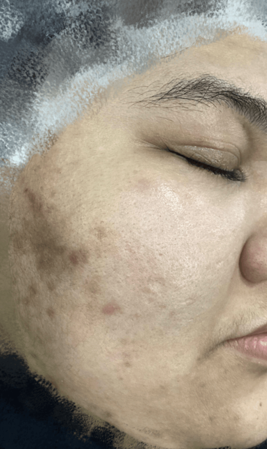PICOPULSE treatment