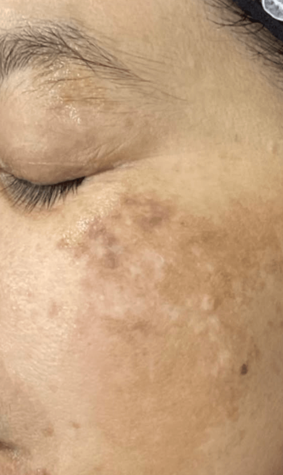 PICOPULSE treatment