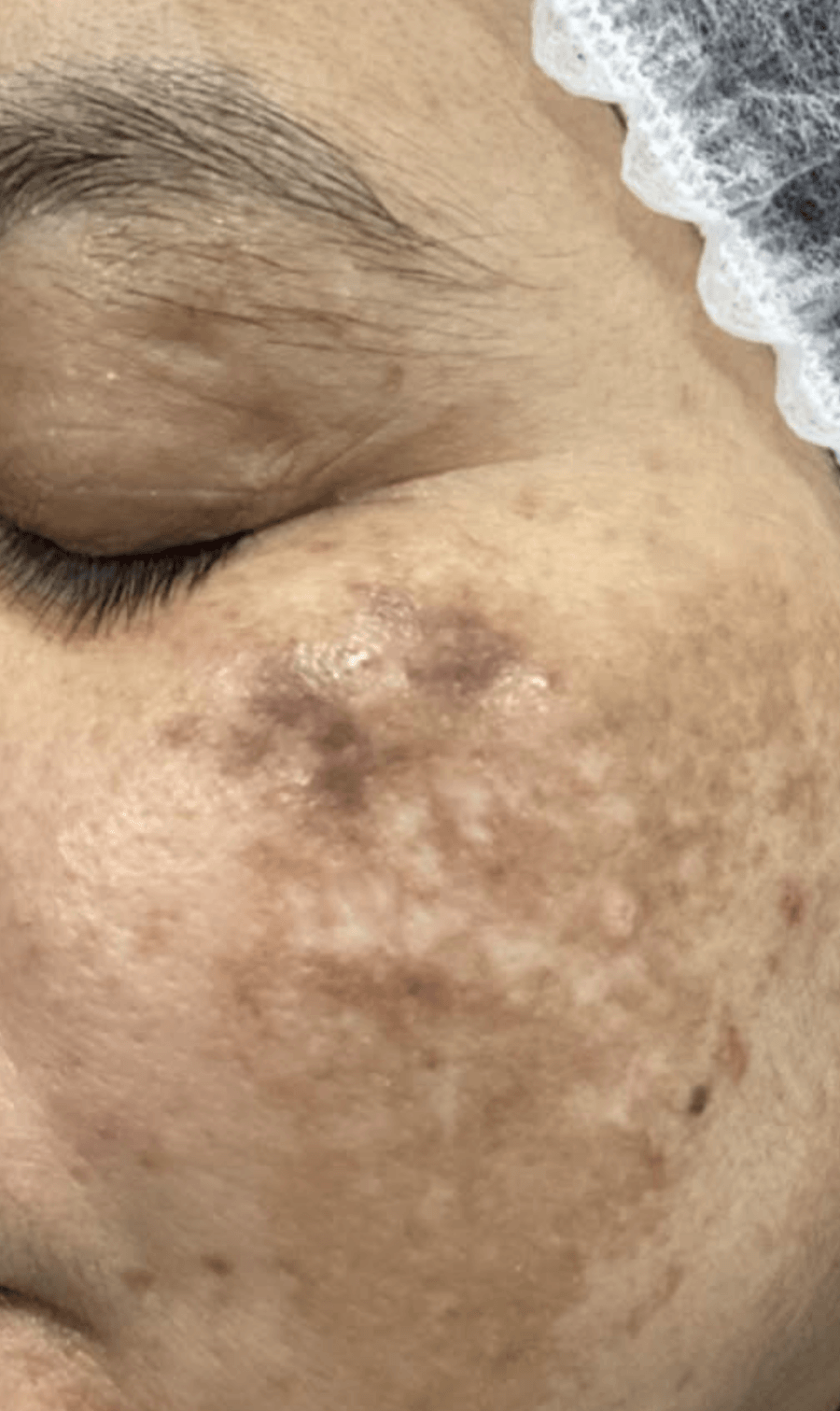 PICOPULSE treatment