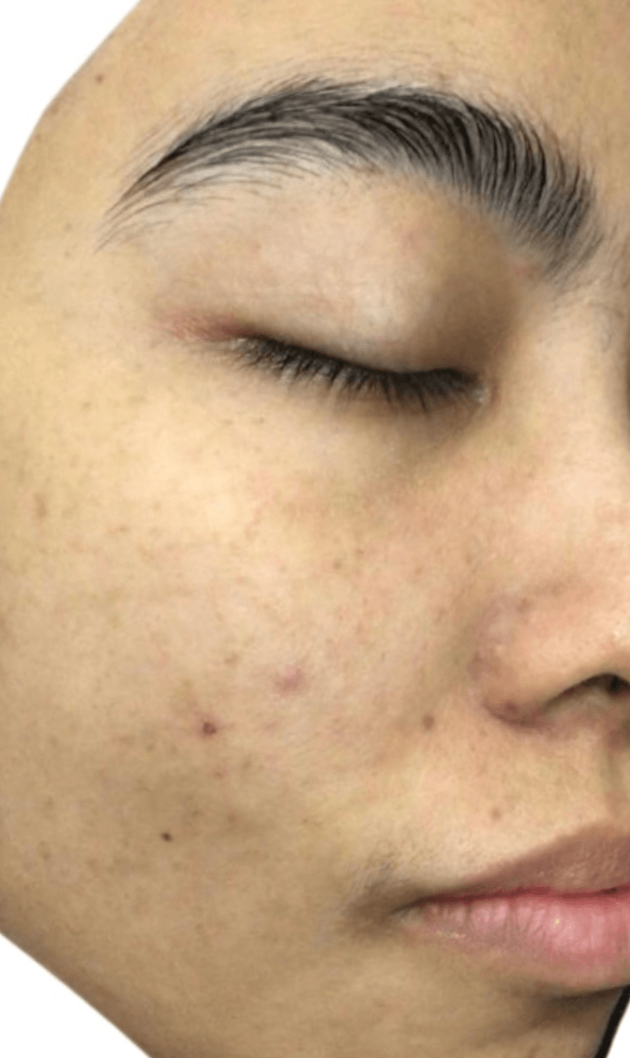 PICOPULSE treatment