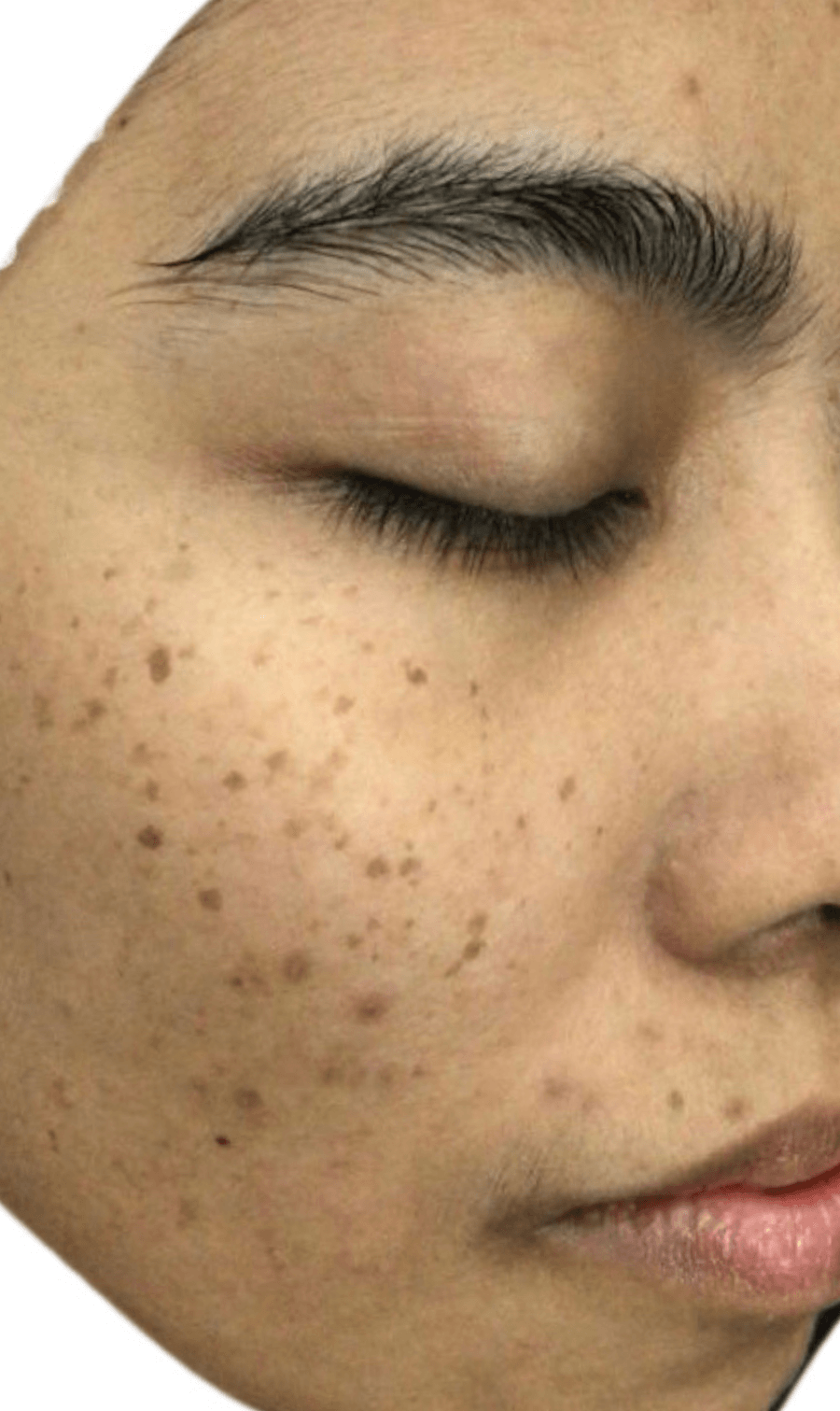 PICOPULSE treatment