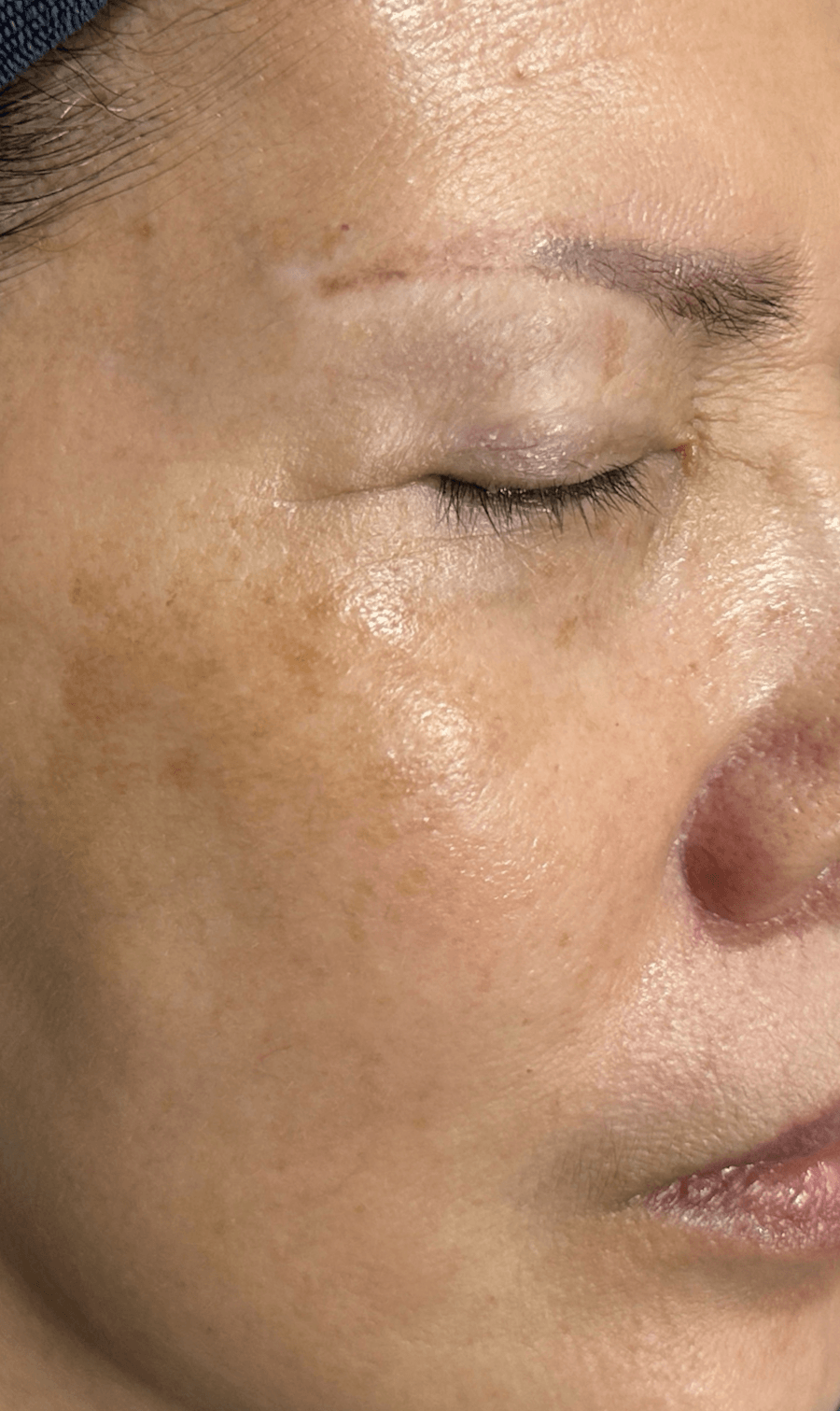 PICOPULSE treatment