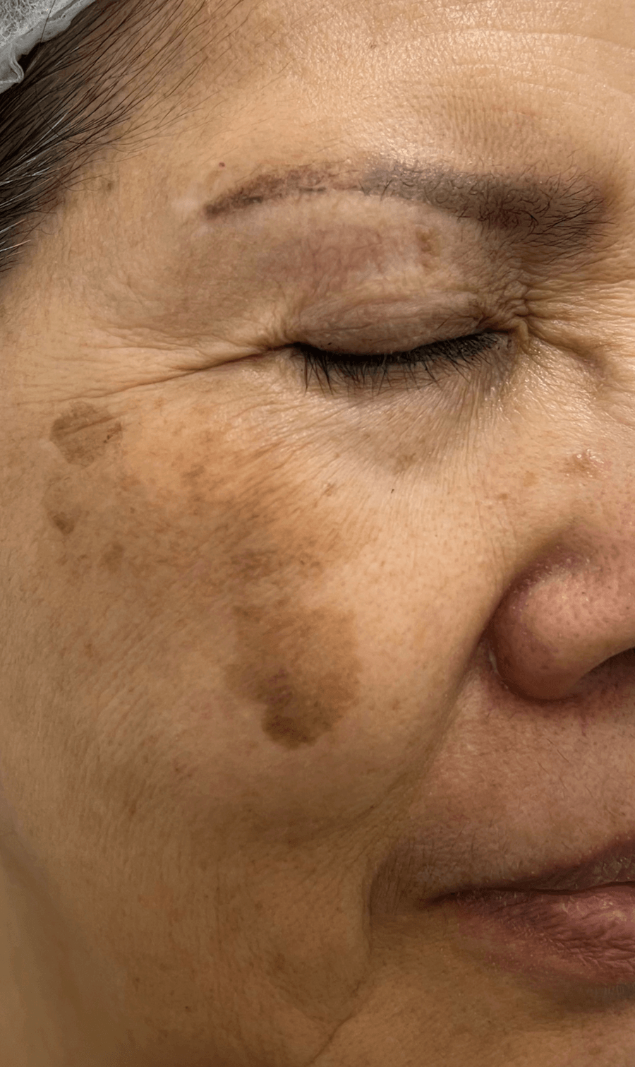 PICOPULSE treatment